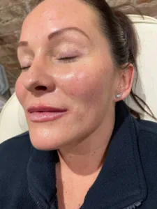 1ml lip filler result at Bedeque Medical, Preston — fuller volume with natural shape